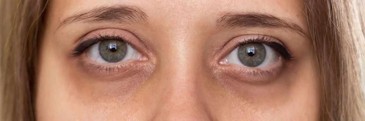 Göz Altı Morlukları İçin Bitkisel Çözüm Yöntemleri