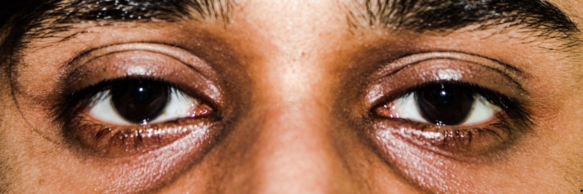 Göz Altı Morlukları İçin Bitkisel ve Doğal Bakım Rehberi